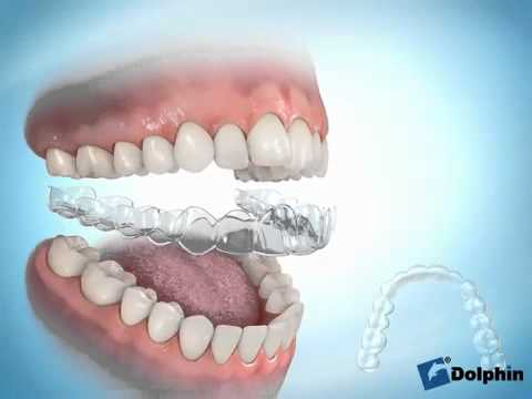 mal aliento invisalign zaragoza